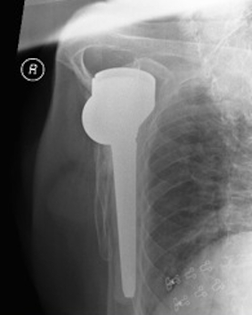 Dislocated Reverse TSR Lateral